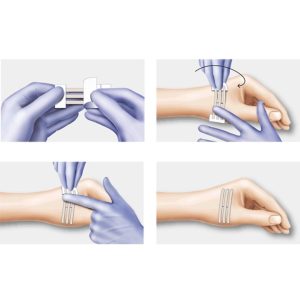 Plasturi pentru inlocuirea suturilor chirurgicale